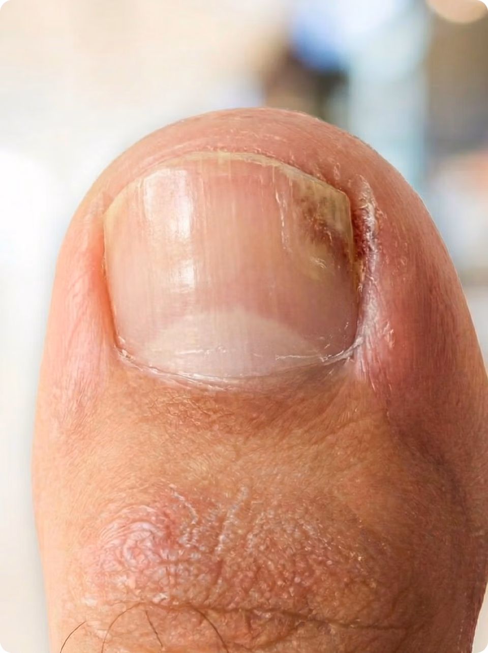 Nagelpilz am groĂen Zehennagel: gelblich verfĂ€rbter, verdickter und brĂŒchiger Nagel