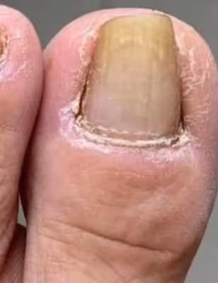 Vorher: Zehennagel mit Nagelpilz vor der Orivelle-Anwendung