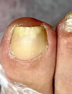 Vorher: gelber, brĂŒchiger Zehennagel mit Nagelpilz